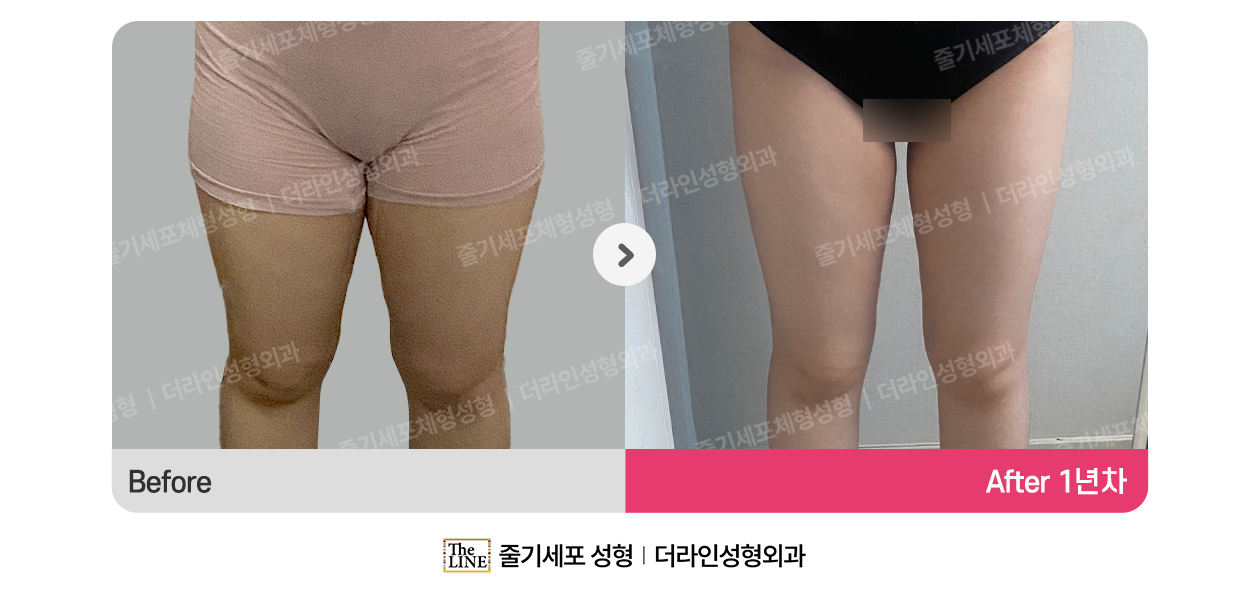 더라인성형외과 시술 상세 이미지