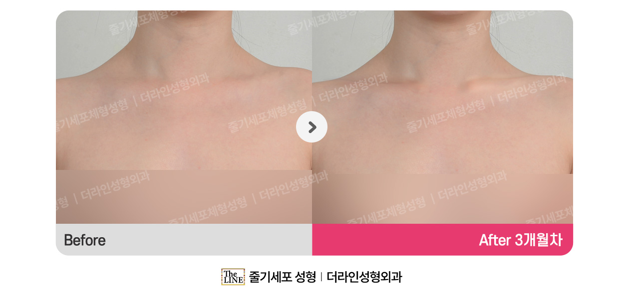 더라인성형외과 시술 상세 이미지