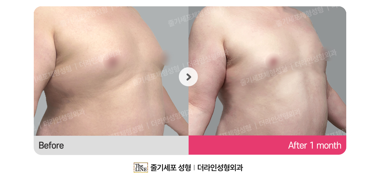더라인성형외과 시술 상세 이미지