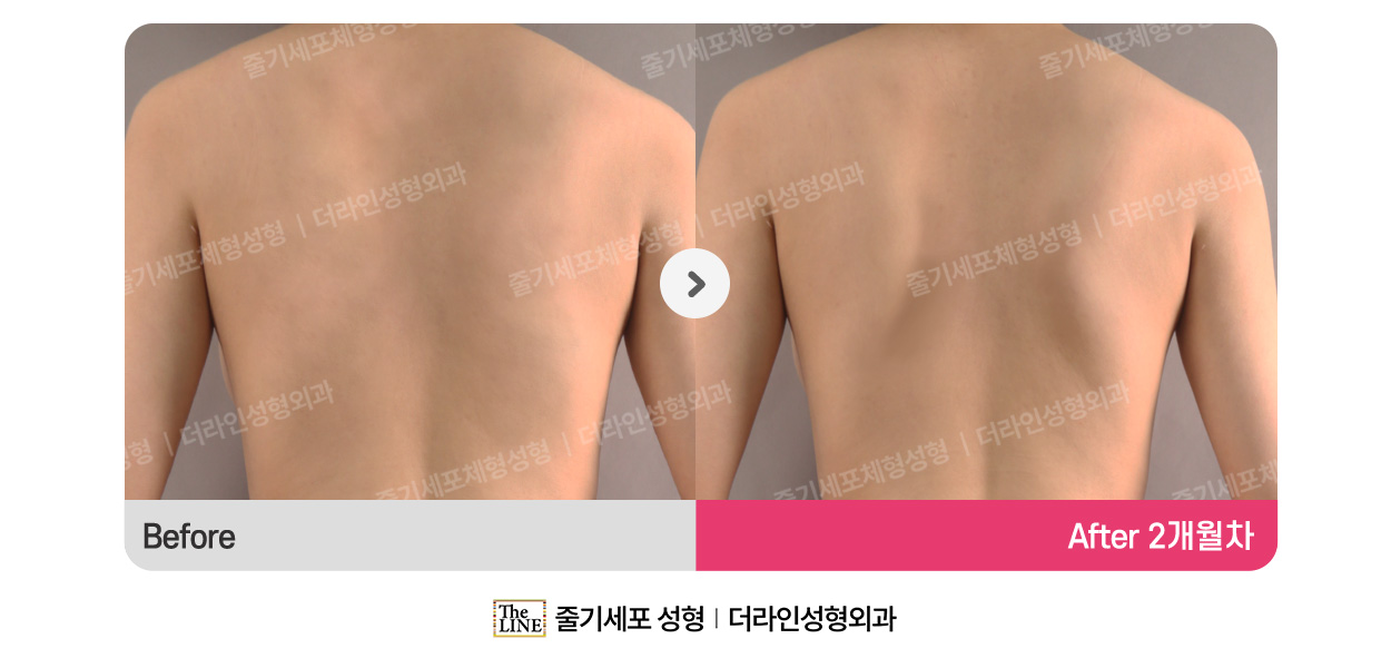 더라인성형외과 시술 상세 이미지