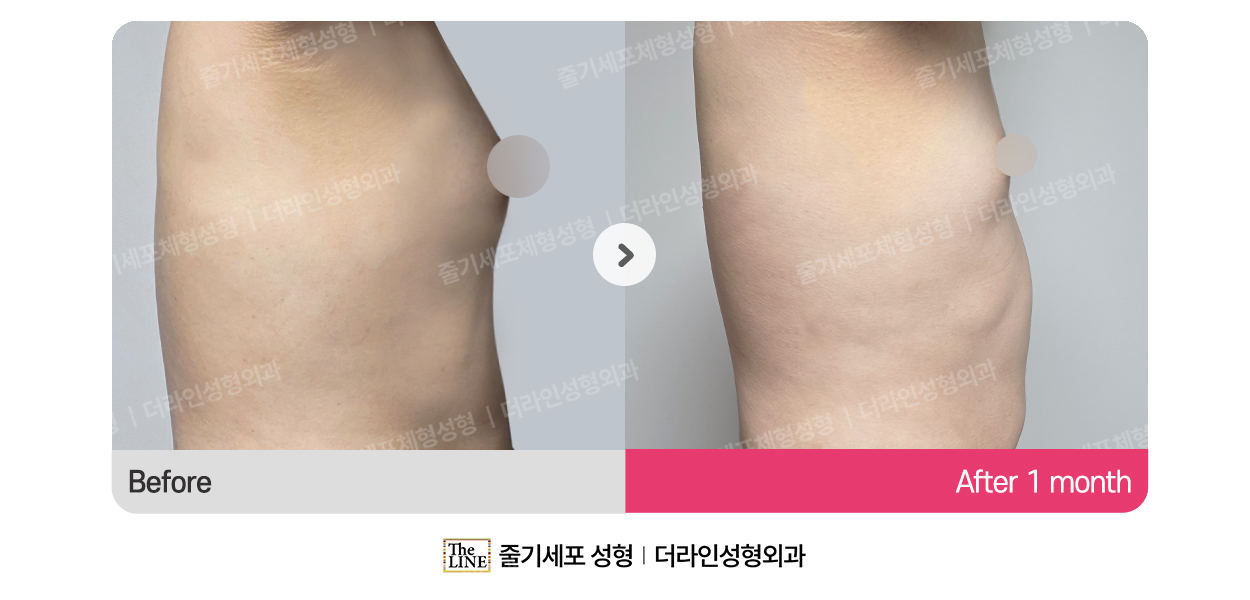 더라인성형외과 시술 상세 이미지