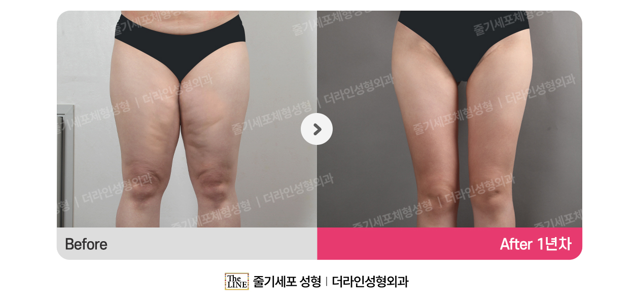 더라인성형외과 시술 상세 이미지