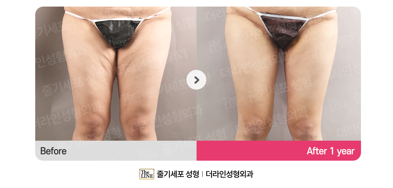 더라인성형외과 시술 상세 이미지