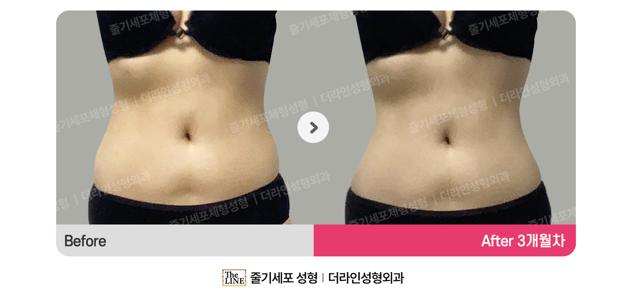 더라인성형외과 시술 상세 이미지