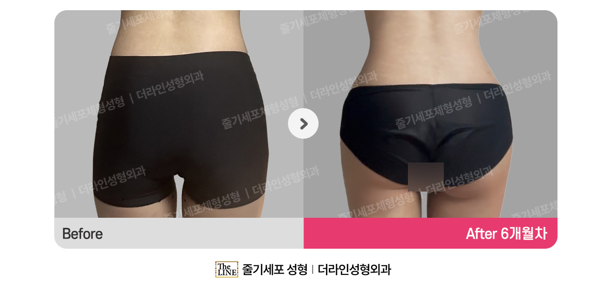 더라인성형외과 시술 상세 이미지