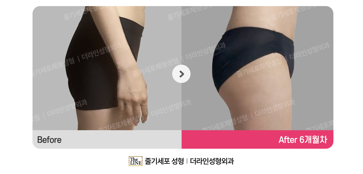 더라인성형외과 시술 상세 이미지