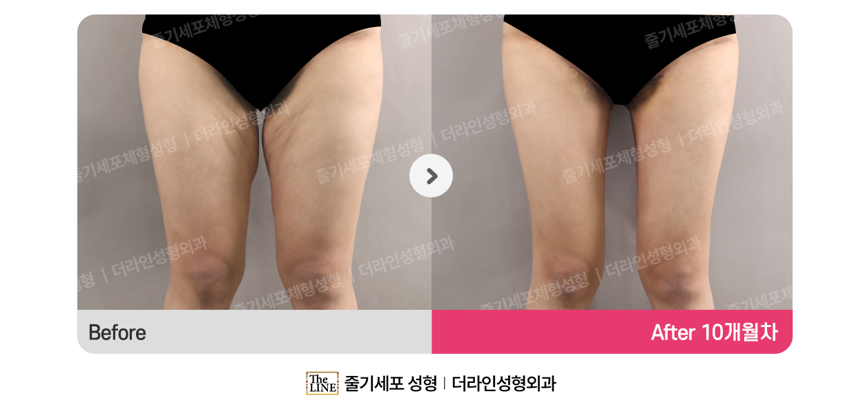 더라인성형외과 시술 상세 이미지