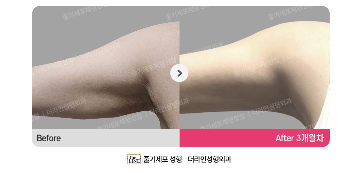 더라인성형외과 시술 상세 이미지