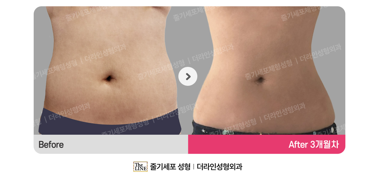 더라인성형외과 시술 상세 이미지