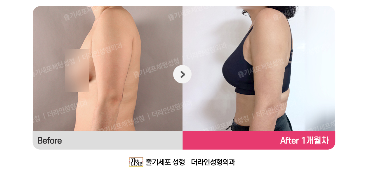 더라인성형외과 시술 상세 이미지