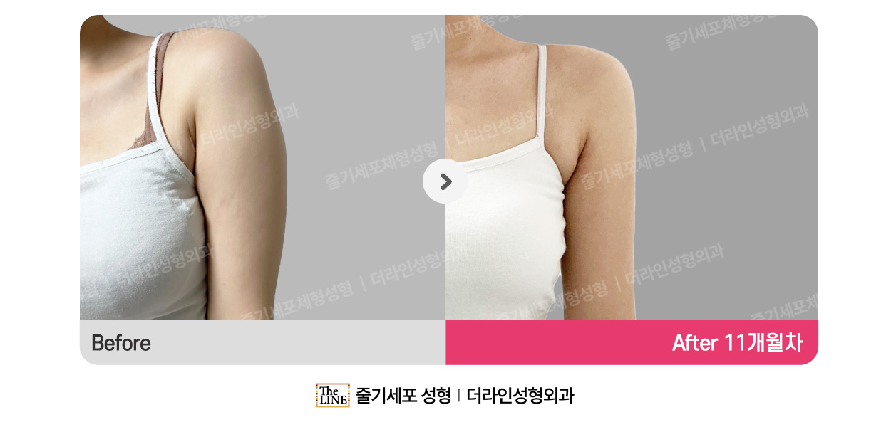 더라인성형외과 시술 상세 이미지