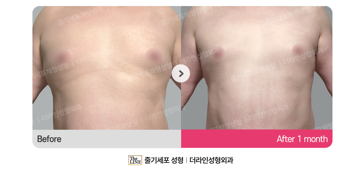 더라인성형외과 시술 상세 이미지
