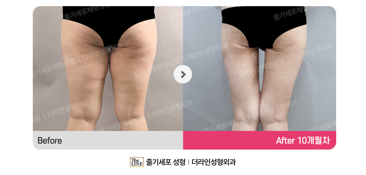 더라인성형외과 시술 상세 이미지