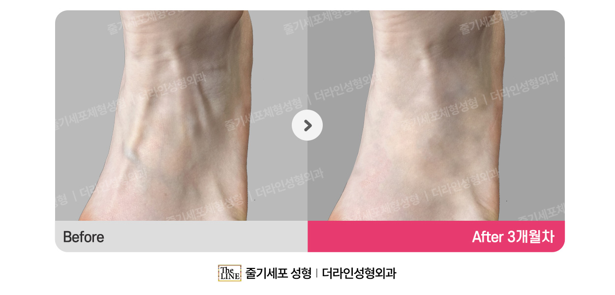더라인성형외과 시술 상세 이미지
