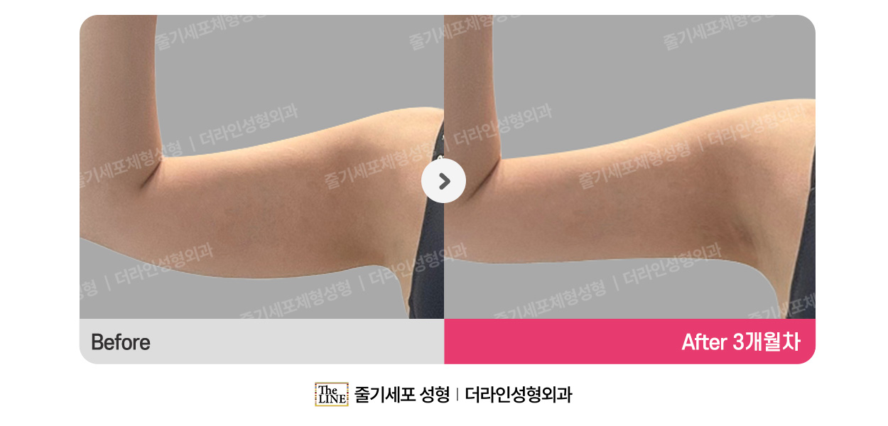 더라인성형외과 시술 상세 이미지