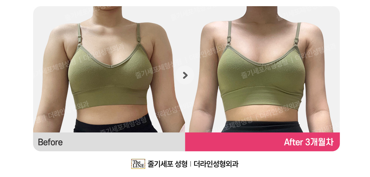더라인성형외과 시술 상세 이미지