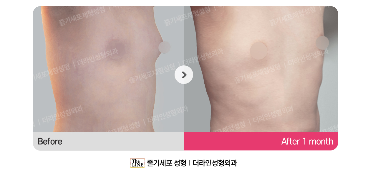 더라인성형외과 시술 상세 이미지