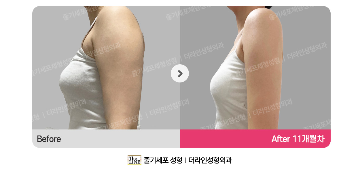더라인성형외과 시술 상세 이미지