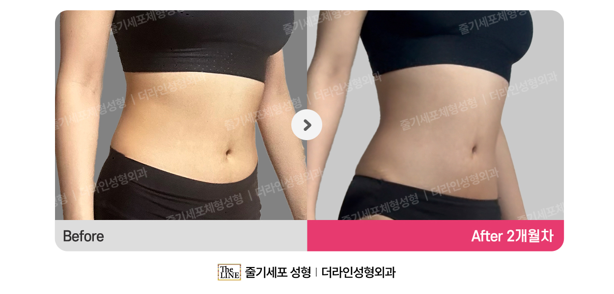 더라인성형외과 시술 상세 이미지