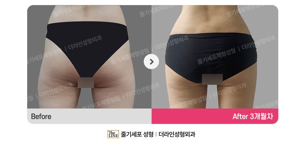 더라인성형외과 시술 상세 이미지