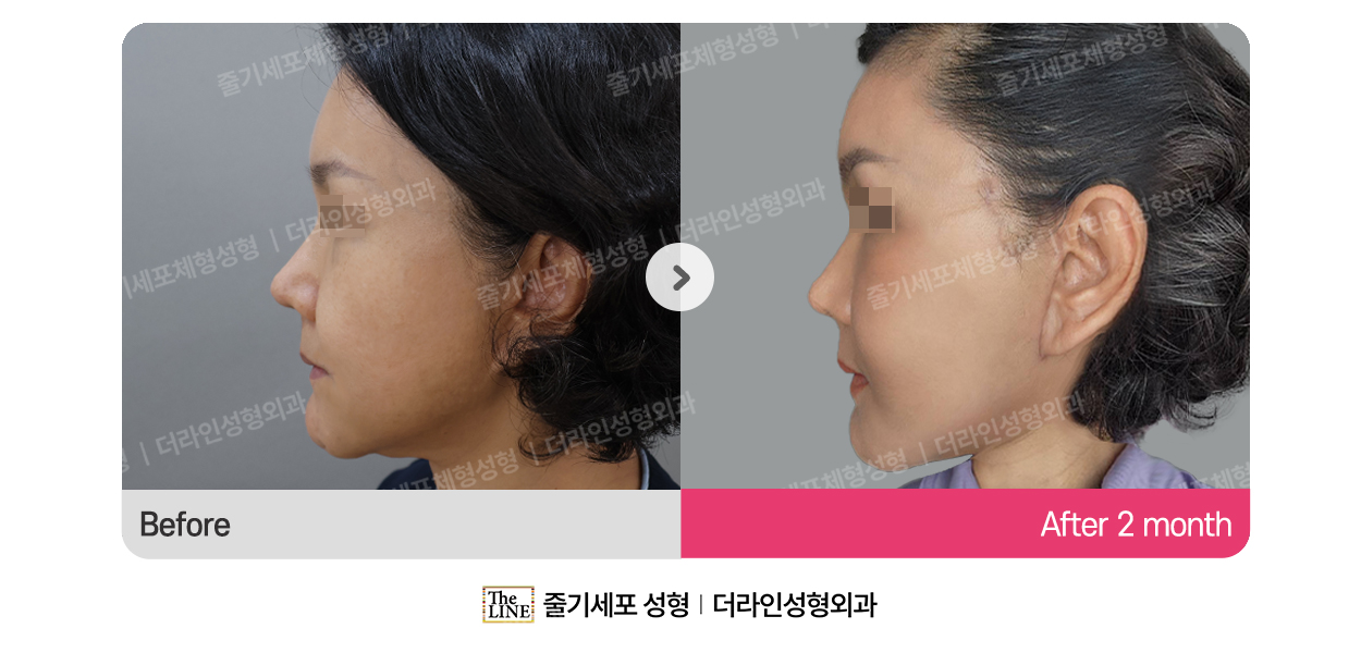 안면거상 대표 이미지