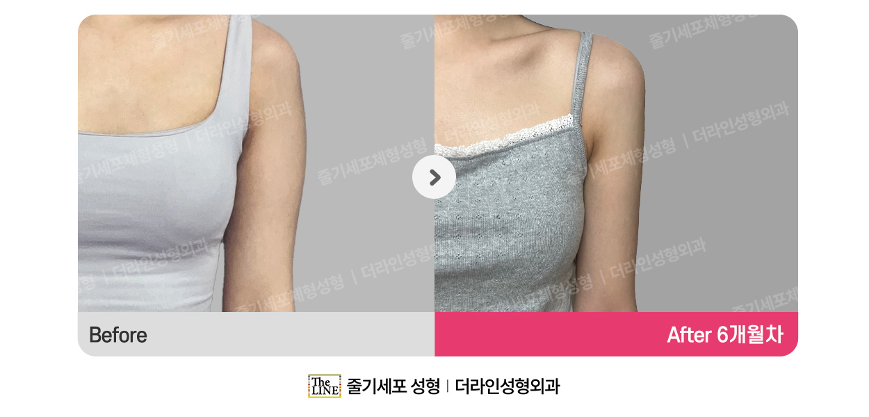 더라인성형외과 시술 상세 이미지