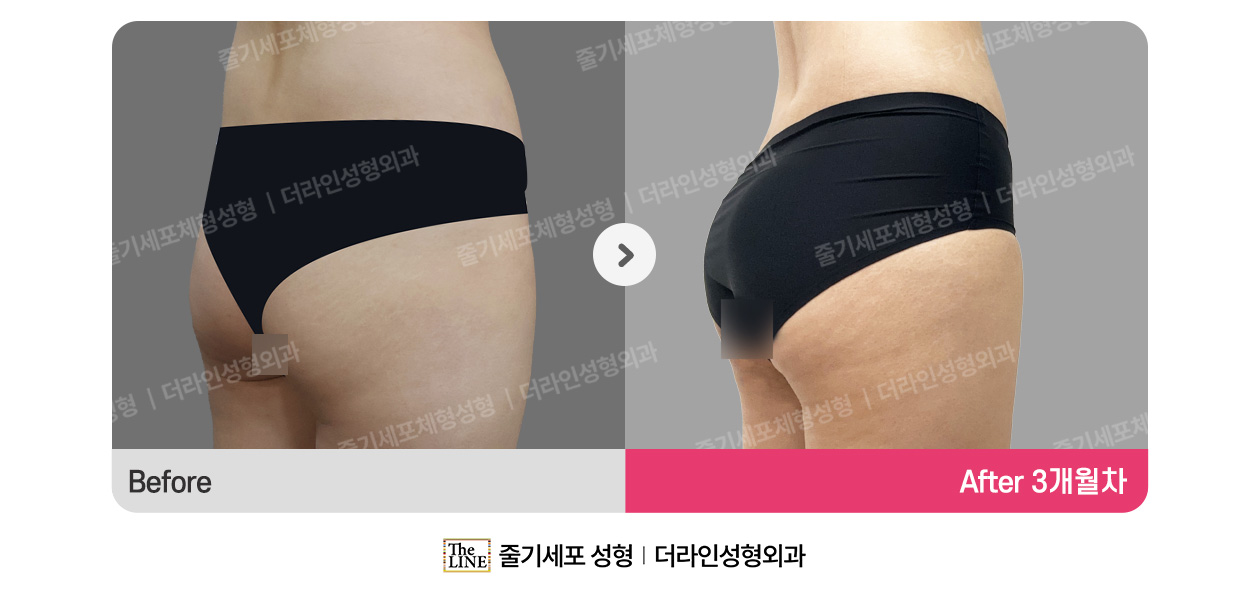 더라인성형외과 시술 상세 이미지