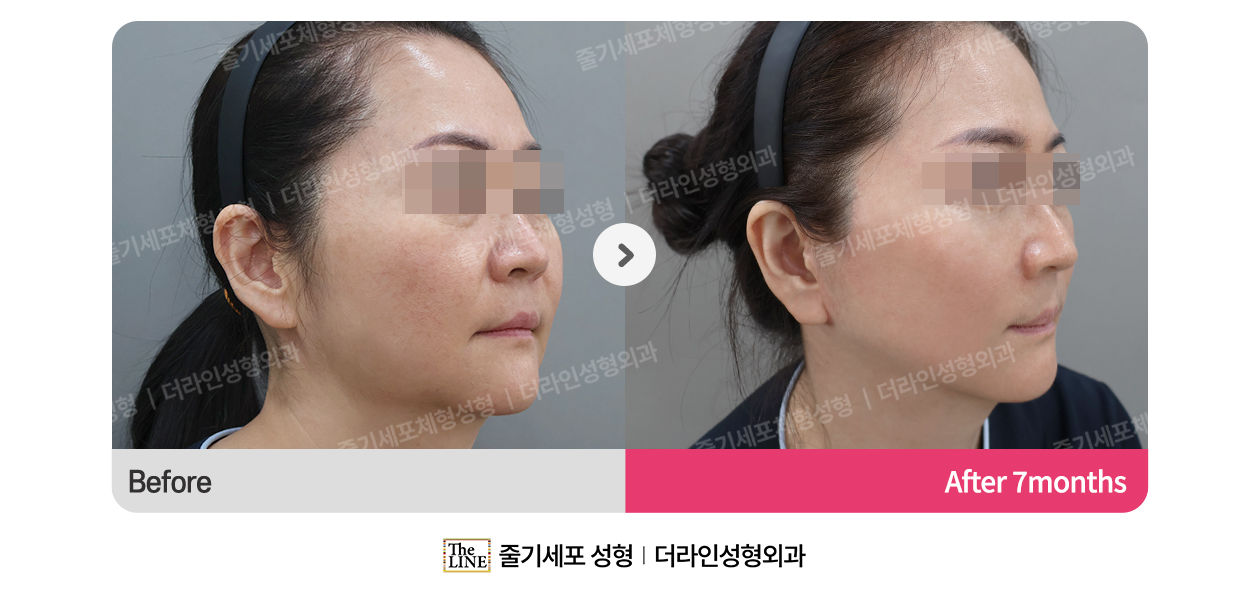 더라인성형외과 시술 상세 이미지