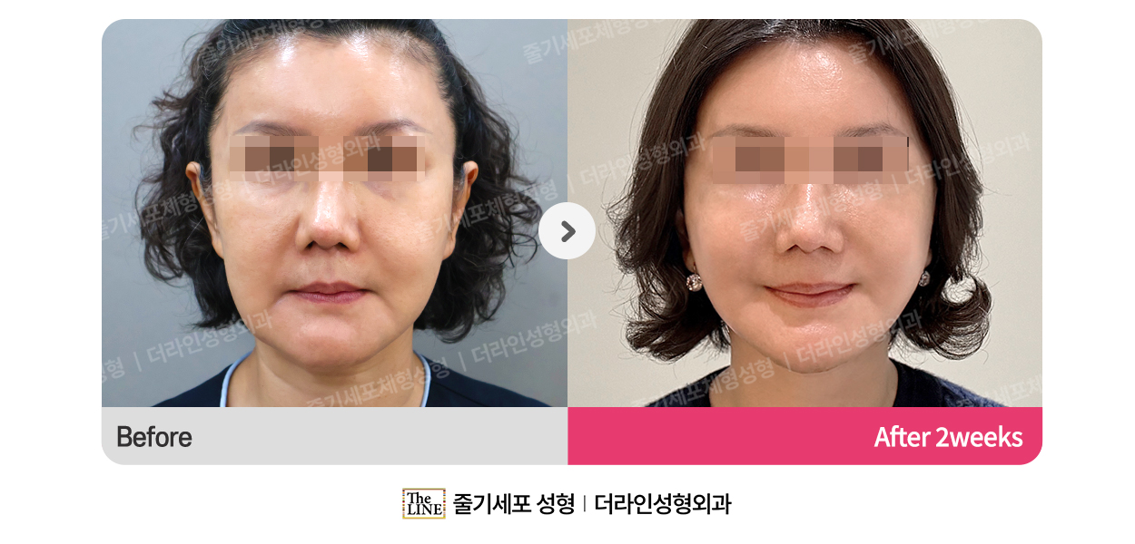 더라인성형외과 시술 상세 이미지