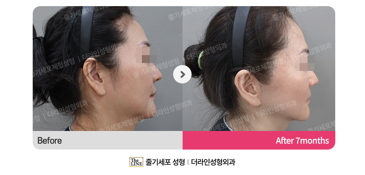 더라인성형외과 시술 상세 이미지