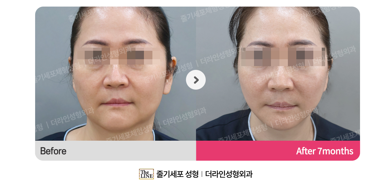 더라인성형외과 시술 상세 이미지
