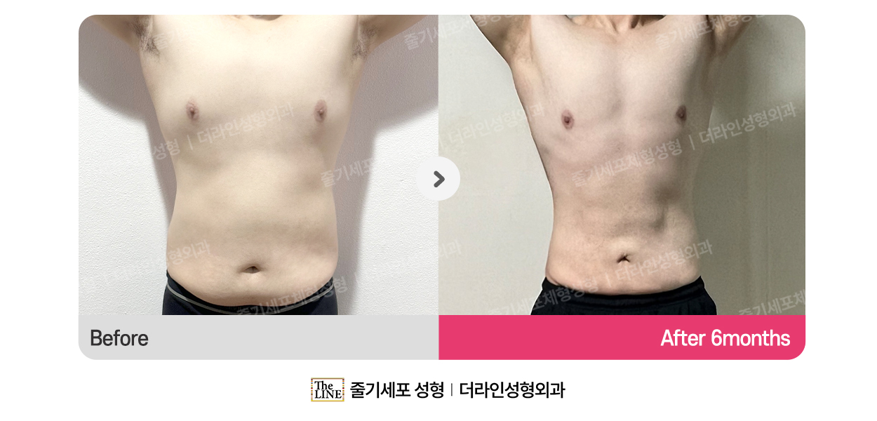더라인성형외과 시술 상세 이미지