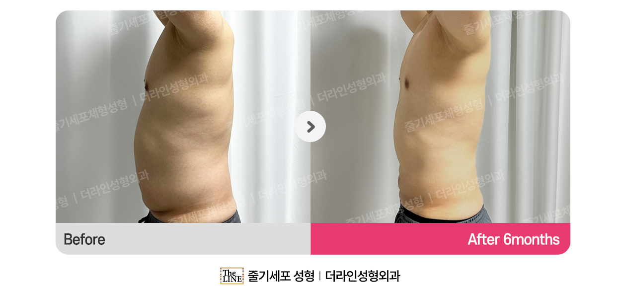 더라인성형외과 시술 상세 이미지