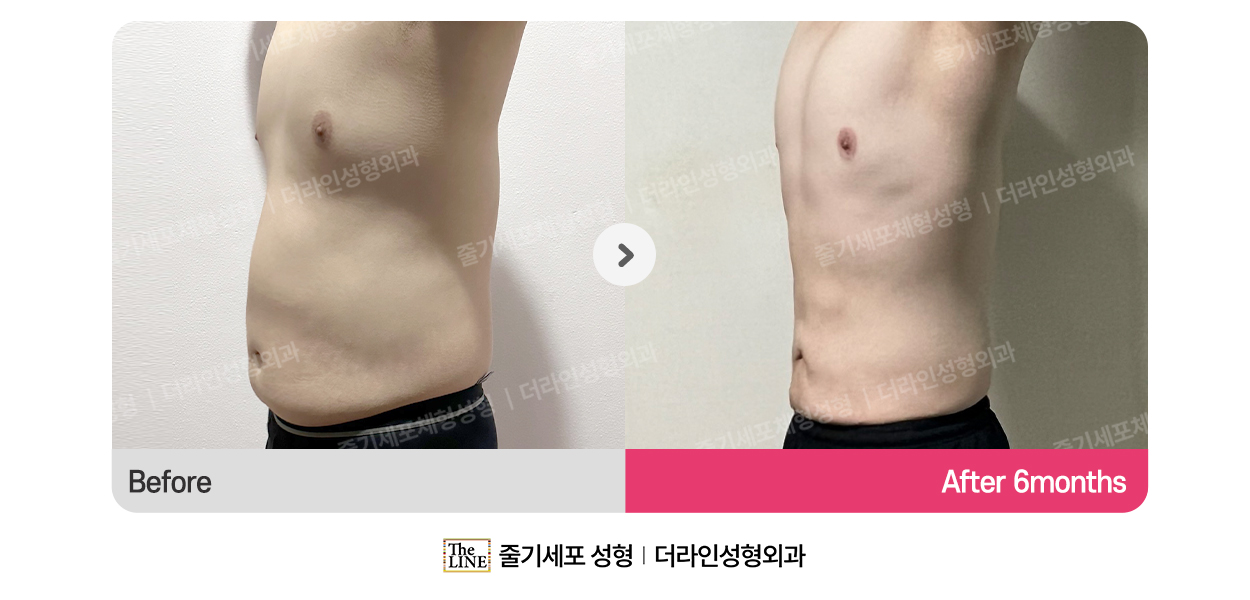 더라인성형외과 시술 상세 이미지