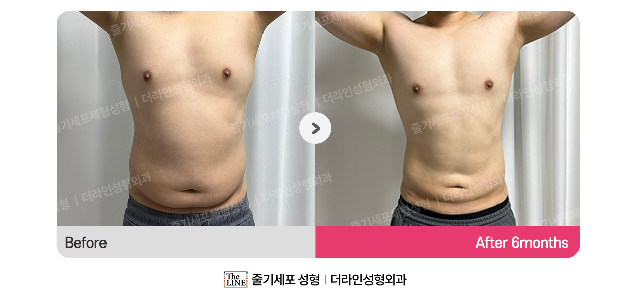 더라인성형외과 시술 상세 이미지