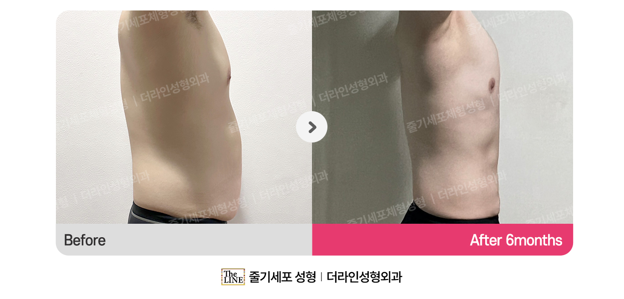 더라인성형외과 시술 상세 이미지