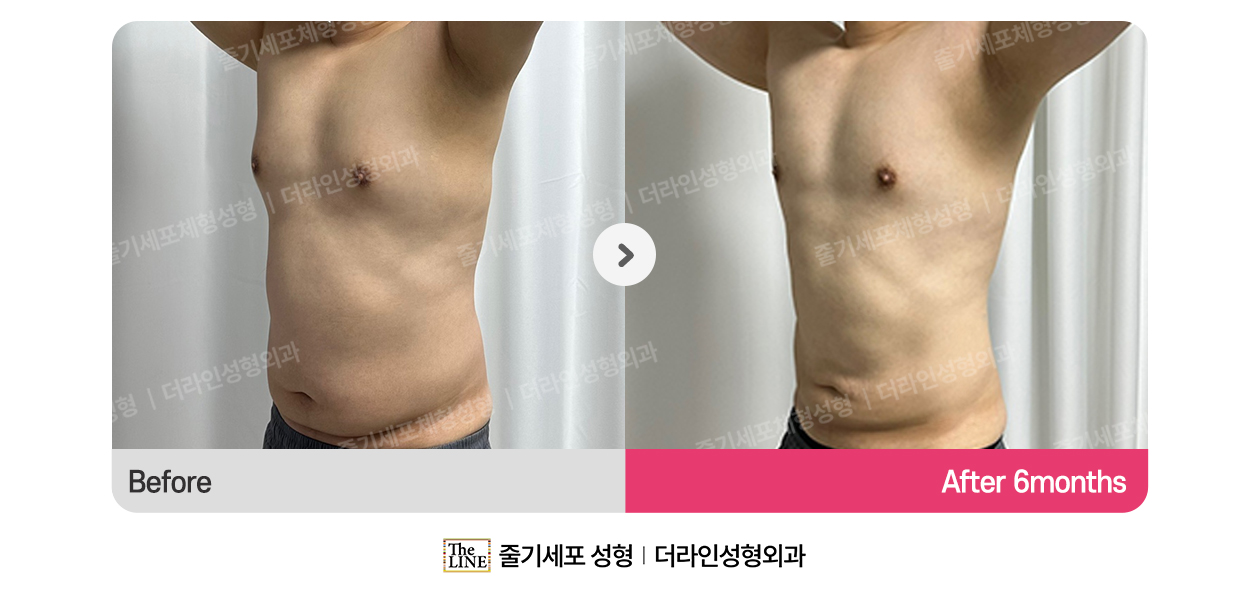 더라인성형외과 시술 상세 이미지